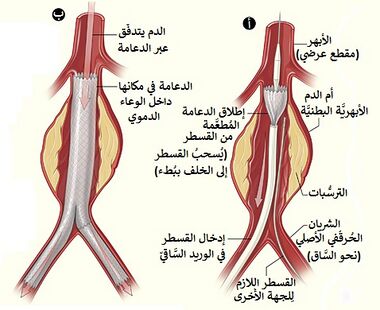 Aneurysm endovascular-ar.jpg