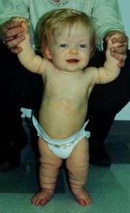 رضيعة مصابة بخلل التنسج العظمي الغضروفي.jpg