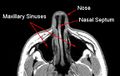 MRI image showing nasal septum.