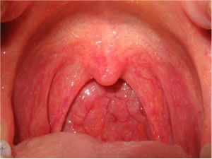 Pharyngitis.jpg
