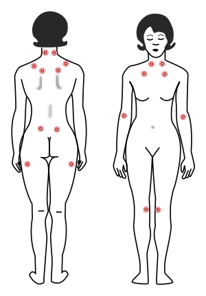 Tender points fibromyalgia svg.svg