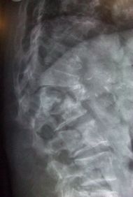 L1 2 vertebral fracture.jpg
