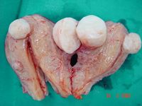 Fibroids; Subtotal hysterectomy.jpg