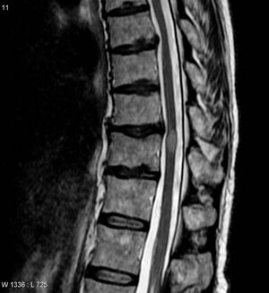 Transverse myelitis MRI.jpg