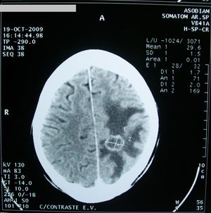 CT brain tumor.jpg