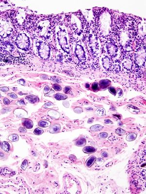 Schistosoma japonicum (1) histopathology.JPG