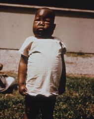 Plasmodium falciparum nephrosis edema PHIL 3894 lores.jpg