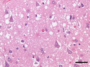 Spongiform degeneration in Creutzfeldt-Jakob disease.jpg