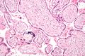 Micrograph of a placental infection (CMV placentitis).
