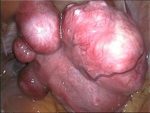 Uterine fibroids.jpg