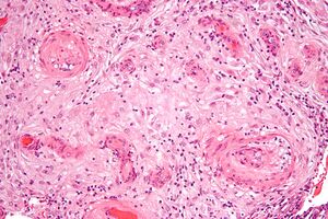 Hypertrophic decidual vasculopathy high mag.jpg