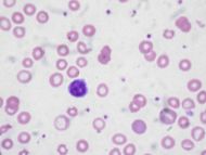 Iron deficiency anemia.jpg