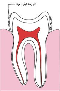 شكل1 نخر الأسنان.jpg