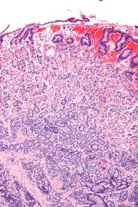 Gastric neuroendocrine tumour - intermed mag.jpg